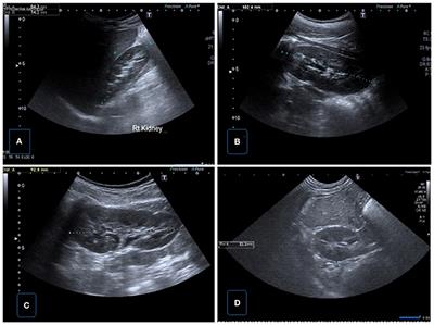 Urinary Ultrasound and Other Imaging for Ureteropelvic Junction Type Hydronephrosis (UPJHN)